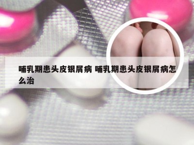 哺乳期患头皮银屑病 哺乳期患头皮银屑病怎么治