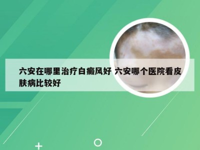 六安在哪里治疗白癜风好 六安哪个医院看皮肤病比较好