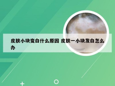 皮肤小块变白什么原因 皮肤一小块发白怎么办