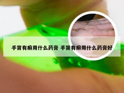 手背有癣用什么药膏 手背有癣用什么药膏好