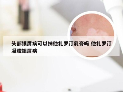 头部银屑病可以抹他扎罗汀乳膏吗 他扎罗汀凝胶银屑病