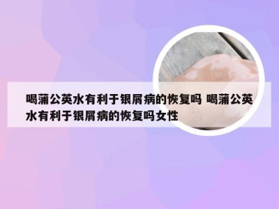 喝蒲公英水有利于银屑病的恢复吗 喝蒲公英水有利于银屑病的恢复吗女性