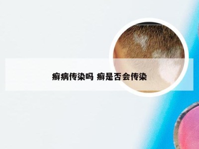 癣病传染吗 癣是否会传染