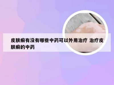 皮肤癣有没有哪些中药可以外用治疗 治疗皮肤癣的中药