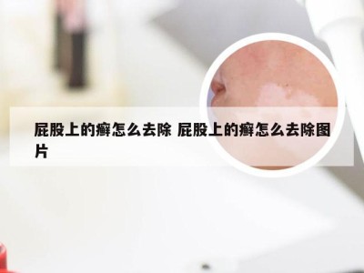 屁股上的癣怎么去除 屁股上的癣怎么去除图片