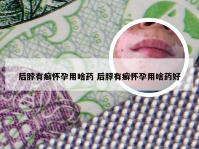 后脖有癣怀孕用啥药 后脖有癣怀孕用啥药好