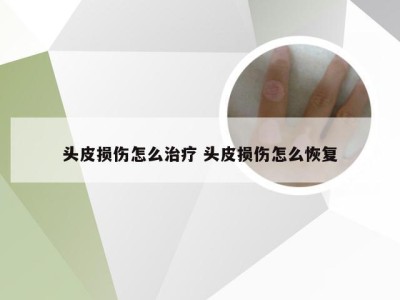 头皮损伤怎么治疗 头皮损伤怎么恢复