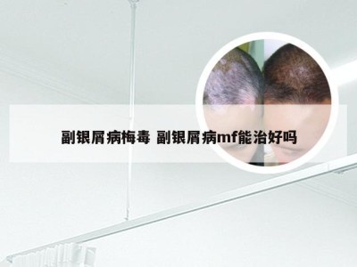 副银屑病梅毒 副银屑病mf能治好吗