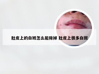 肚皮上的白班怎么能除掉 肚皮上很多白斑