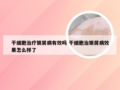 干细胞治疗银屑病有效吗 干细胞治银屑病效果怎么样了