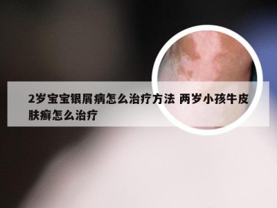 2岁宝宝银屑病怎么治疗方法 两岁小孩牛皮肤癣怎么治疗