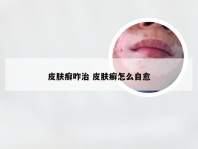 皮肤癣咋治 皮肤癣怎么自愈