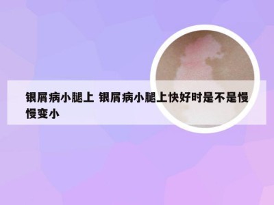 银屑病小腿上 银屑病小腿上快好时是不是慢慢变小