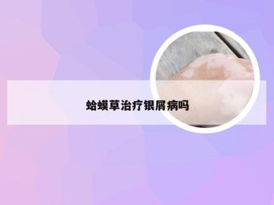 蛤蟆草治疗银屑病吗