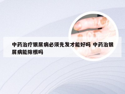 中药治疗银屑病必须先发才能好吗 中药治银屑病能除根吗