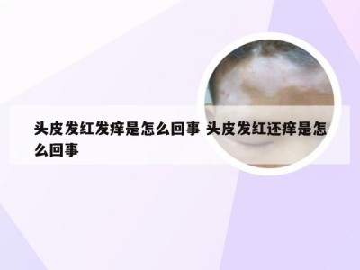 头皮发红发痒是怎么回事 头皮发红还痒是怎么回事