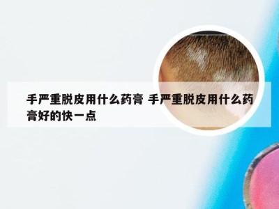 手严重脱皮用什么药膏 手严重脱皮用什么药膏好的快一点