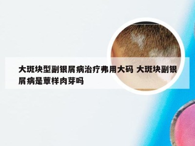 大斑块型副银屑病治疗弗用大码 大斑块副银屑病是蕈样肉芽吗