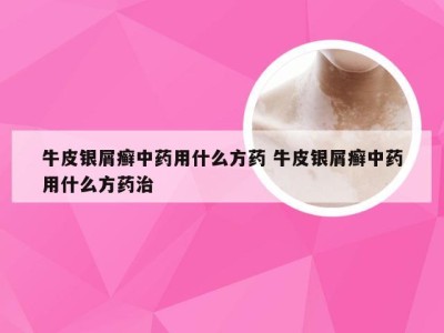 牛皮银屑癣中药用什么方药 牛皮银屑癣中药用什么方药治