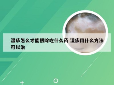 湿疹怎么才能根除吃什么药 湿疹用什么方法可以治