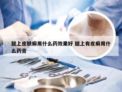 腿上皮肤癣用什么药效果好 腿上有皮癣用什么药膏