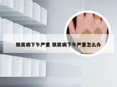 银屑病下午严重 银屑病下午严重怎么办