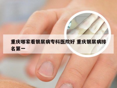 重庆哪家看银屑病专科医院好 重庆银屑病排名第一