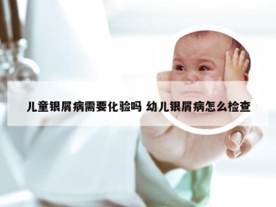 儿童银屑病需要化验吗 幼儿银屑病怎么检查