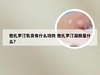 他扎罗汀乳膏有什么功效 他扎罗汀凝胶是什么?