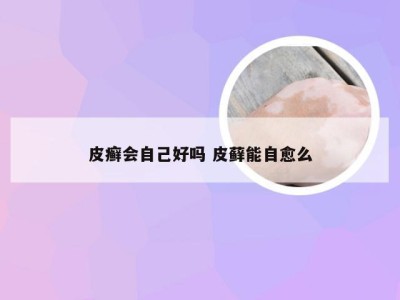 皮癣会自己好吗 皮藓能自愈么