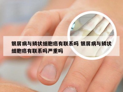 银屑病与鳞状细胞癌有联系吗 银屑病与鳞状细胞癌有联系吗严重吗