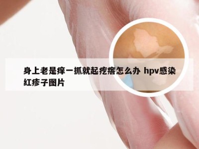 身上老是痒一抓就起疙瘩怎么办 hpv感染红疹子图片