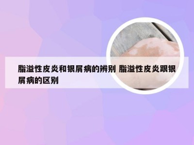 脂溢性皮炎和银屑病的辨别 脂溢性皮炎跟银屑病的区别