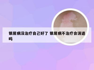 银屑病没治疗自己好了 银屑病不治疗会消退吗