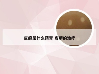 皮癣是什么药膏 皮癣的治疗