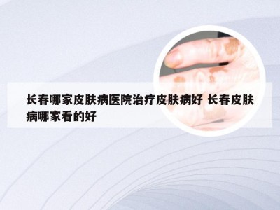 长春哪家皮肤病医院治疗皮肤病好 长春皮肤病哪家看的好