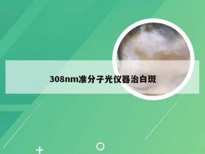 308nm准分子光仪器治白斑