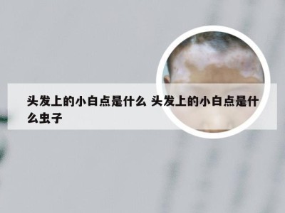 头发上的小白点是什么 头发上的小白点是什么虫子