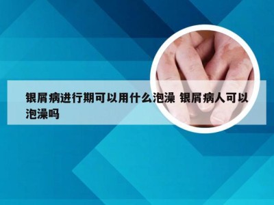 银屑病进行期可以用什么泡澡 银屑病人可以泡澡吗