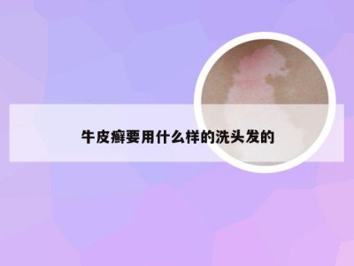 牛皮癣要用什么样的洗头发的