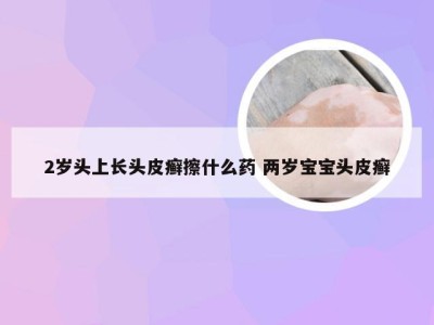 2岁头上长头皮癣擦什么药 两岁宝宝头皮癣