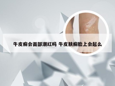 牛皮癣会面部潮红吗 牛皮肤癣脸上会起么