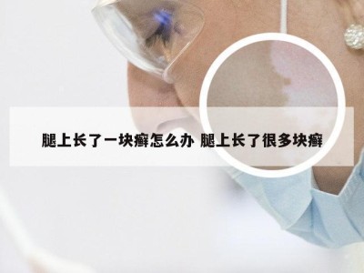 腿上长了一块癣怎么办 腿上长了很多块癣