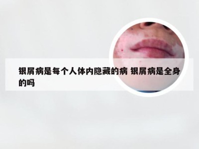 银屑病是每个人体内隐藏的病 银屑病是全身的吗