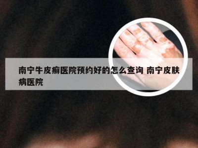 南宁牛皮癣医院预约好的怎么查询 南宁皮肤病医院