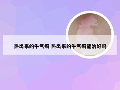 热出来的牛气癣 热出来的牛气癣能治好吗