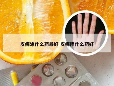 皮癣涂什么药最好 皮癣擦什么药好