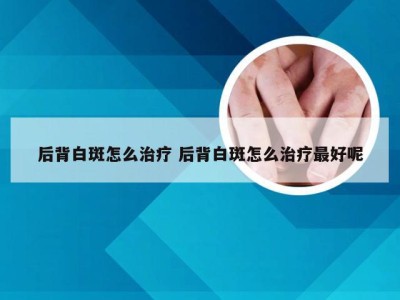 后背白斑怎么治疗 后背白斑怎么治疗最好呢