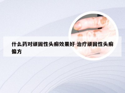 什么药对顽固性头癣效果好 治疗顽固性头癣偏方