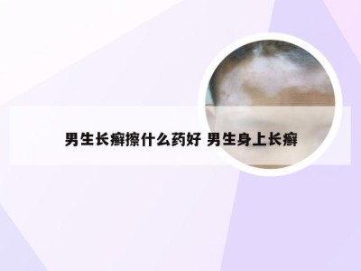 男生长癣擦什么药好 男生身上长癣